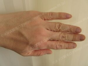 手の甲の医療脱毛3回目：自己処理の頻度が減ってきた様子