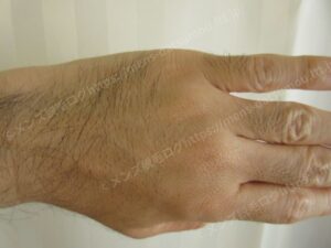 40代メンズ医療脱毛：手の甲と指の施術前の状態