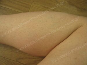 すね（脛）の医療脱毛3回目：広範囲で毛が多少薄くなった減毛効果