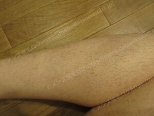 40代男性のすね毛：医療脱毛を開始する前の状態