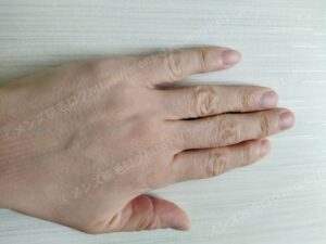 40代男性の医療脱毛完了後：手の甲の毛の状態（2024年6月最終施術）