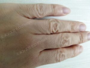 医療脱毛完了後の手の甲拡大写真：毛穴が目立たず清潔感のある肌