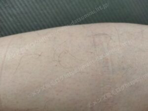 すねの毛穴と肌の質感拡大：医療脱毛による永久的な減毛効果の証明