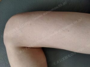 40代メンズ全身脱毛の効果：太ももの広範囲な減毛状態