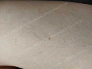 太ももの医療脱毛完了後の拡大：太い毛が消失し自己処理不要な状態