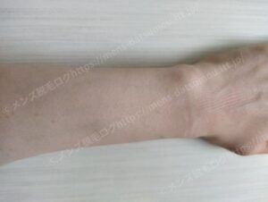 ブランクリニック全身脱毛完了後の上腕：7回照射後の経過写真