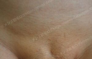 40代男性のVライン医療脱毛9回完了後の経過写真:湘南美容クリニックでの追加照射による変化