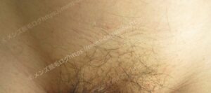 ブランクリニックVIO脱毛7回完了後の効果：40代男性の減毛率と清潔感の変化