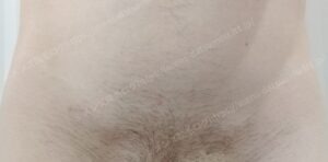 40代男性のVIO医療脱毛：施術前のアンダーヘアの状態（Vライン）